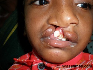 A child with cleft lip