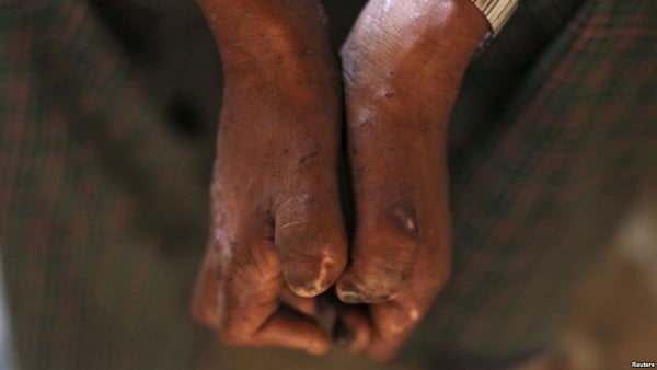 A patient shows the effects of leprosy on his hands