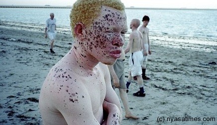 Victims of a growing trade in albino body parts.