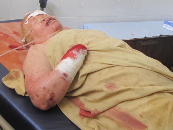 Albino woman who was chopped in Chitipa