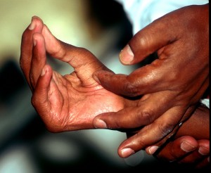 Lperosy fears hit Balaka Lepra patient at ALERT (All Africa Leprosy & Rehabilitation Training Center) in Addis-Abeba, Ethiopia. Physiotherapy, hand tendons to allow to grip things again June 2002 Copyright : WHO/P. Virot