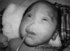 Malawi baby without a nose its ‘Arhinia’ condition - doctors