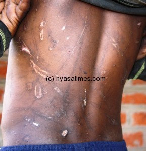 The boy showing part of his scarred body Pic. By Kondwani Magombo