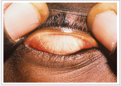 Trachoma Eye Disease