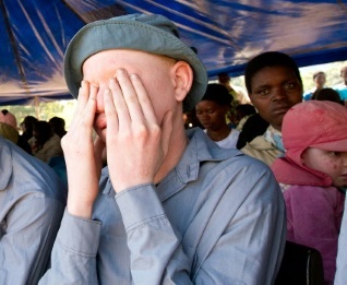 Malawians living with albinism have expressed concern that, besides living in constant fear of being abducted or killed, they also endure painful ridicule as some citizens pour scorn on them. 