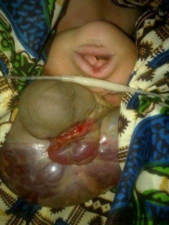 Baby with abnormal features born in Balaka