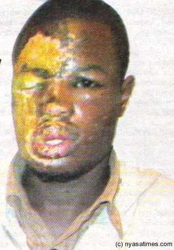 Amos Mwenyemuzi: Burned on duty but abandoned by employer Plastico