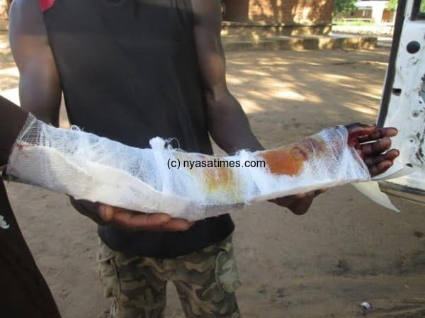 victim's hand after first aid at Utale 2 health centre.-Photo by Sella Pumani, Nyasa Times
