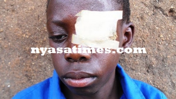 Precius with his bruised eye